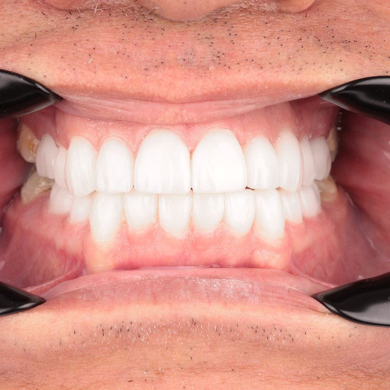 After treatment — E-max ceramic crowns, bright and lifelike