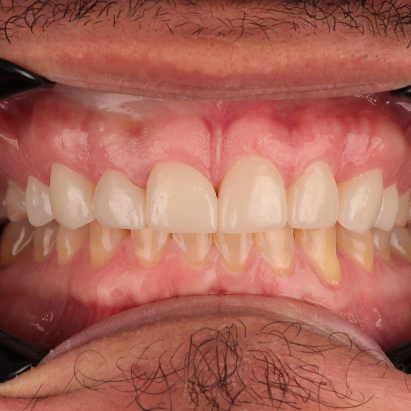After treatment — porcelain veneers, bright and natural