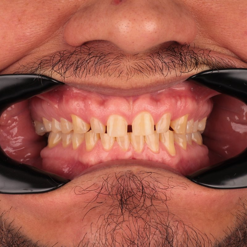 Before treatment — worn, yellowed and uneven teeth