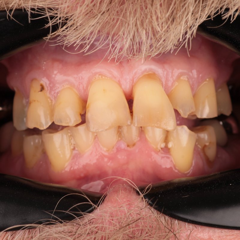 Before treatment — worn, stained and uneven teeth